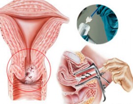 HPV