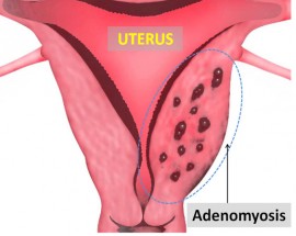 adenomyosis