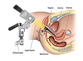 colposcopy