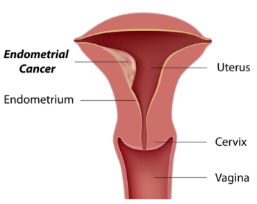 endometrial-cancer