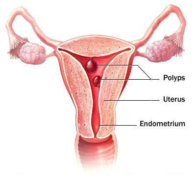endometrial-polyp
