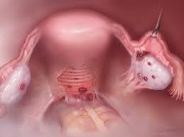 endometriosis
