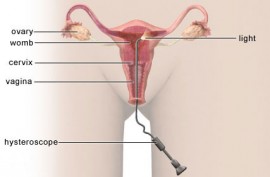 hysteroscopy-main