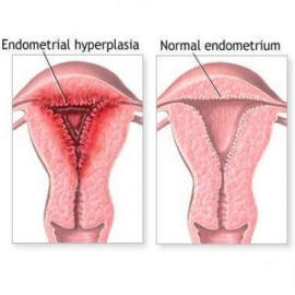 irregular-menstrual-bleeding