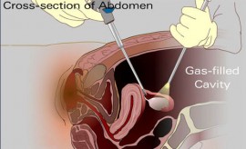 laparoscopy